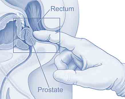 examen de la prostate en anglais